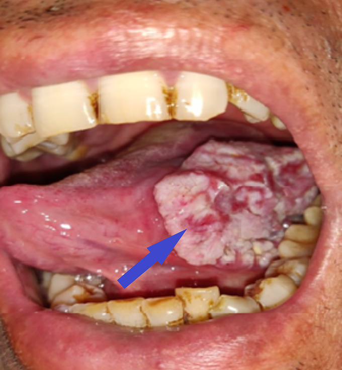 Cancers Associated With Smoking