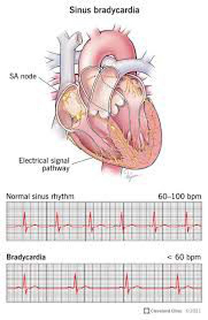 Treatment for bradycardia