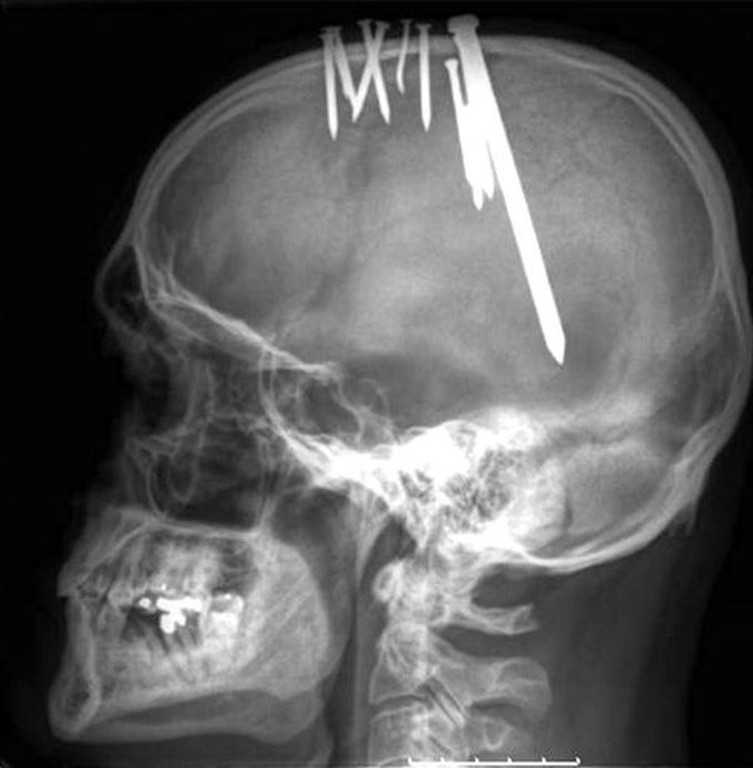A horrible case of a 44 year psychiatric patient. Read the story!