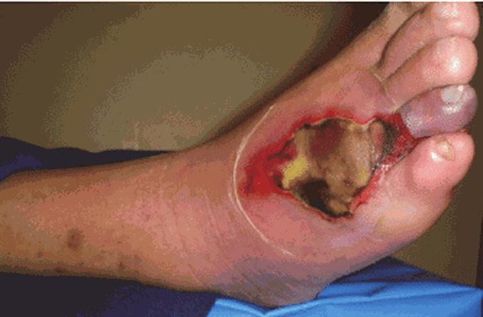 Diabetic foot infection