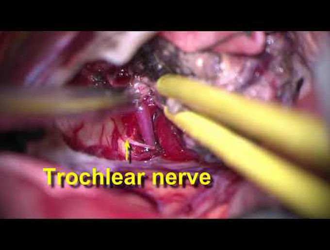 Hybrid endovascular and microsurgical treatment for large mesencephalic-cerebellar hemangioblastoma