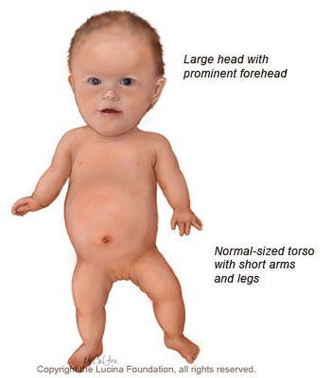 achondroplasia vs normal