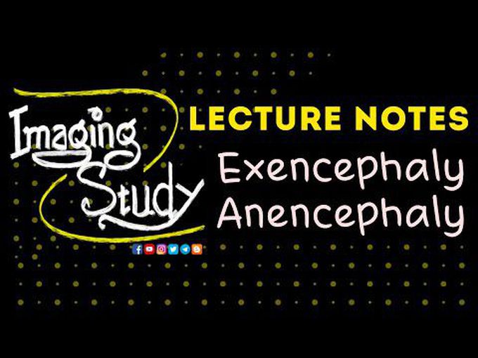 Exencephaly and Anencephaly