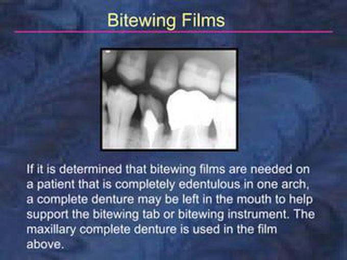 Bitewing radiograph