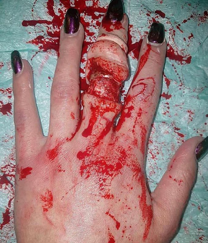 Ring avulsion injury!!!