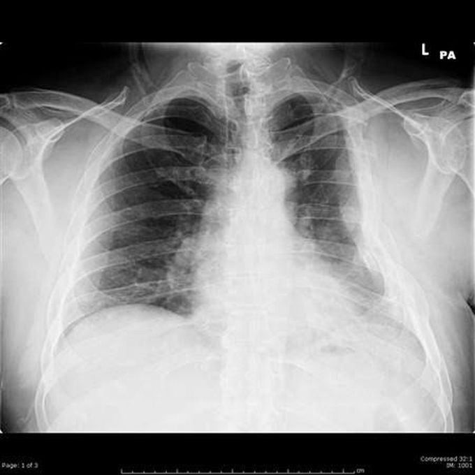 Flial chest causes