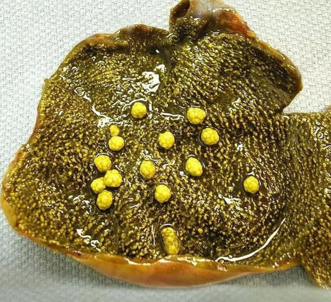 Strawberry Gallbladder