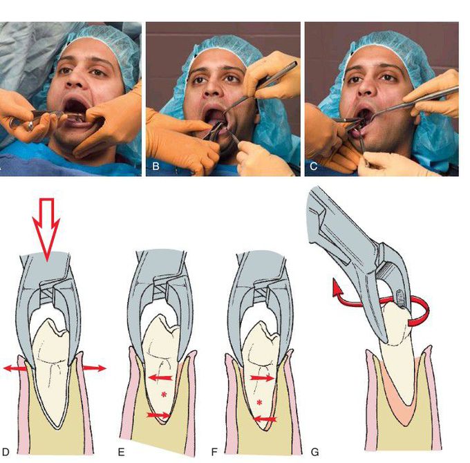 Mandibular premolar extraction