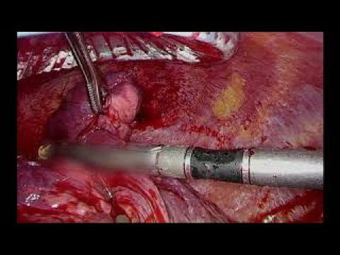 Intraoperative Management of Pulmonary Artery Bleeding with Hemostatic Agents