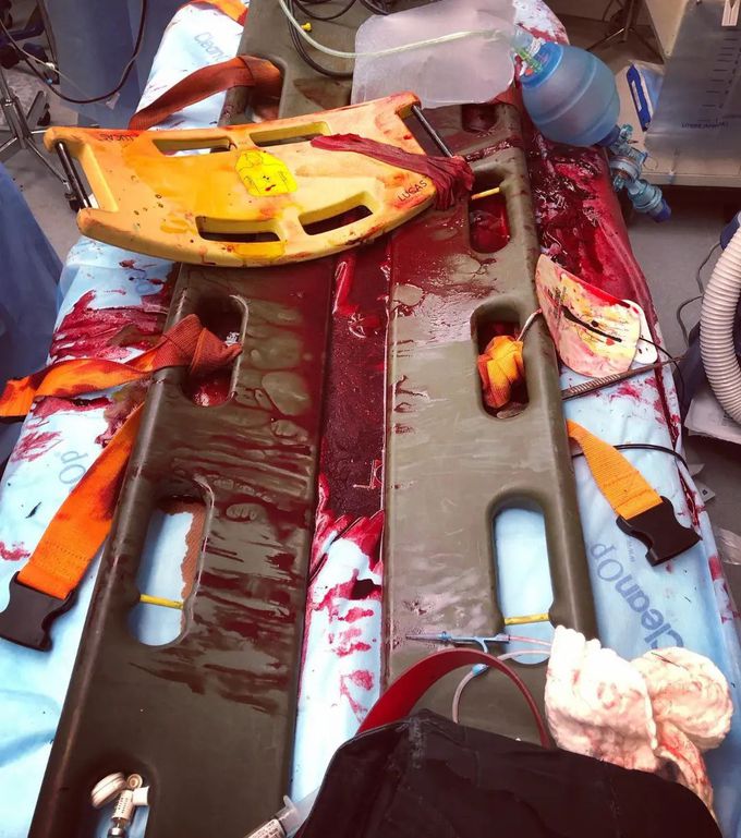 Aftermath of a Gunshot Patient
