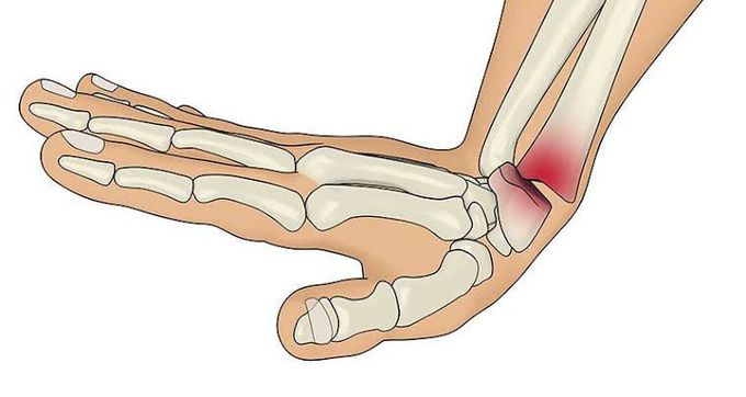 Smith's fracture treatment