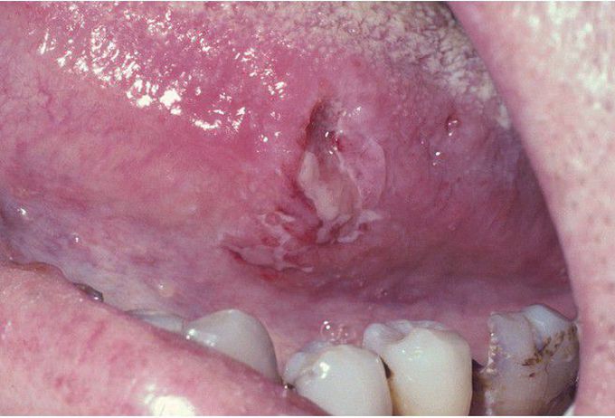 Histoplasmosis