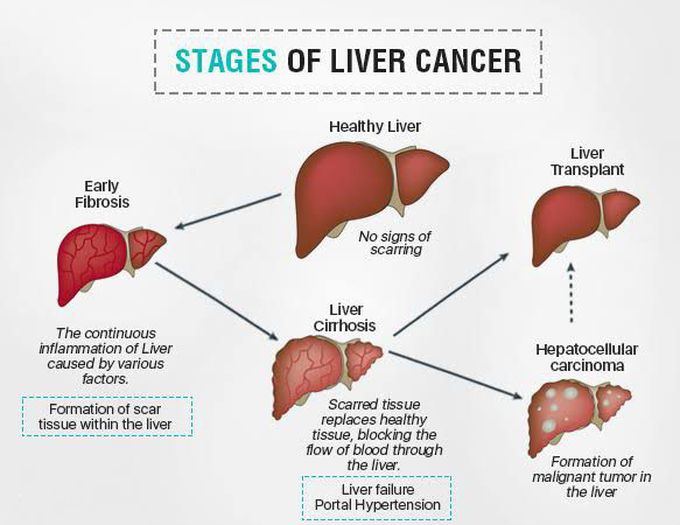 These are the stages of Liver cancer