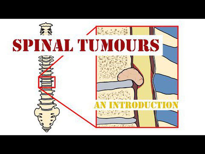 Spinal Tumors: Introduction