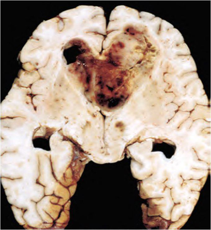 Glioblastoma