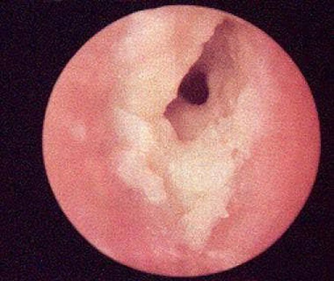 Causes of otitis externa