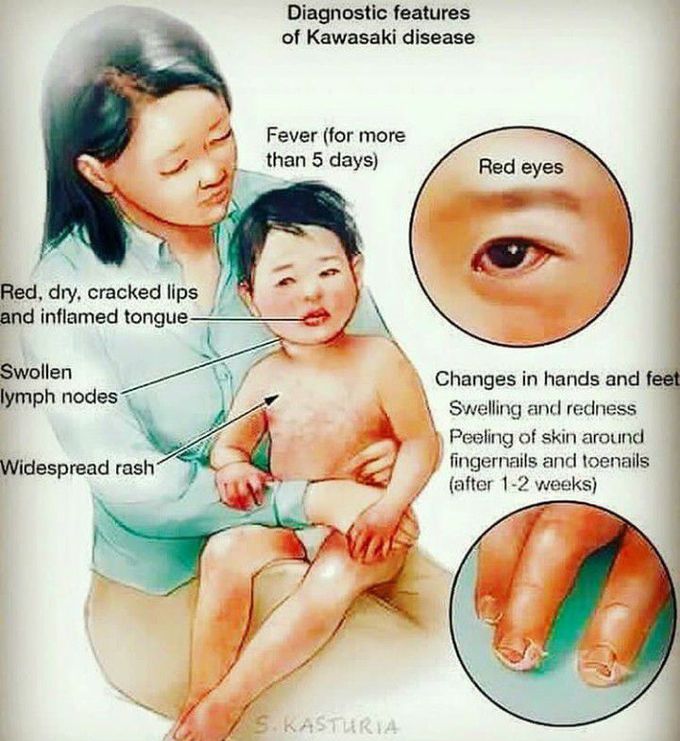 KAWASAKI DISEASE
