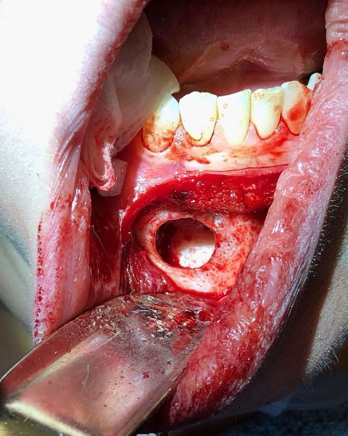 Cavitation in the lower jaw!! 