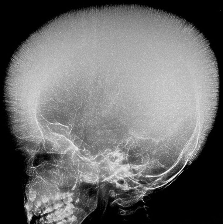 Name this radiographic sign?? Differential diagnosis??? - MEDizzy