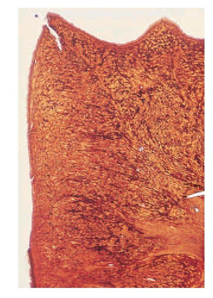 Microscopic appearance of dentinogenesis imperfecta