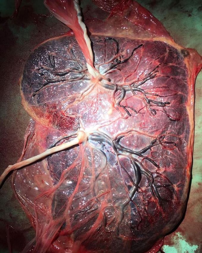 The fetal surface of a normal term identical Monochorionic twin placenta is seen here 