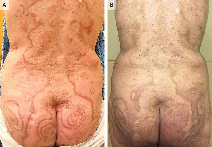 Erythema Gyratum Repens Associated with Anal Cancer