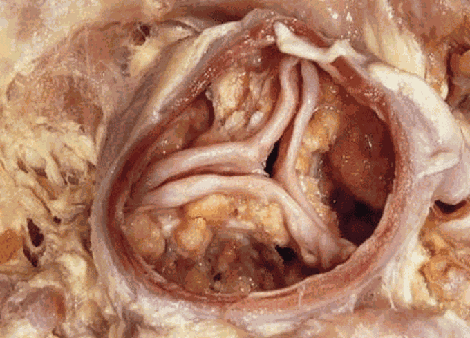 Calcified Aortic Valve
