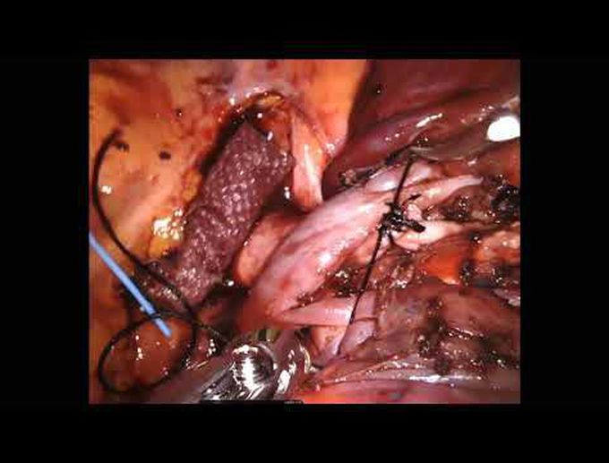 Robotic-Assisted Left Upper Lobe Anterior (S3) Segmentectomy
