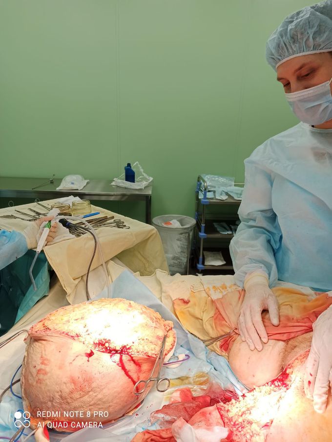 Giant tumor of leg. Histology in process