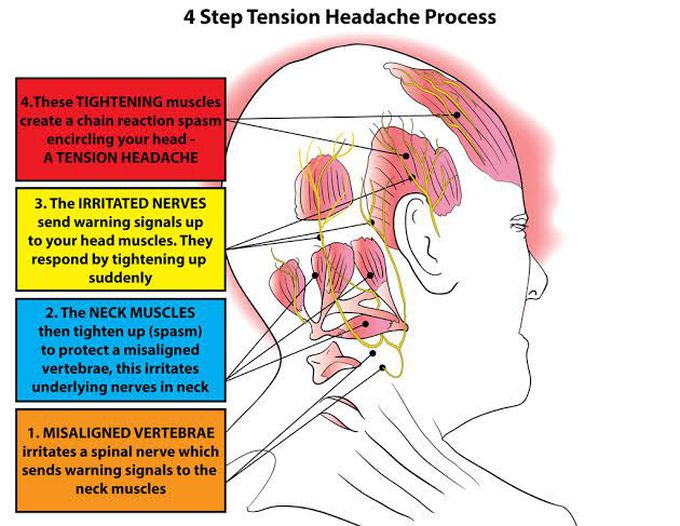 Tension headache