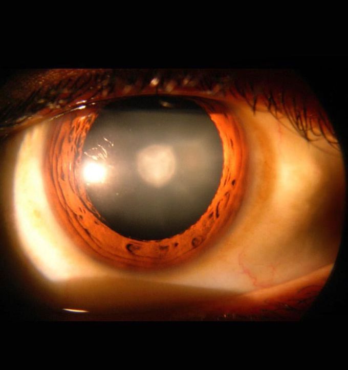 THE POSTERIOR POLAR CATARACT