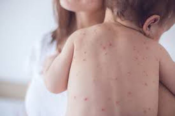 Symptoms of measles