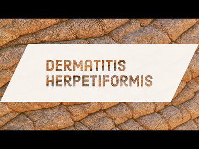 Pathogenesis of Dermatitis Herpetiformis.