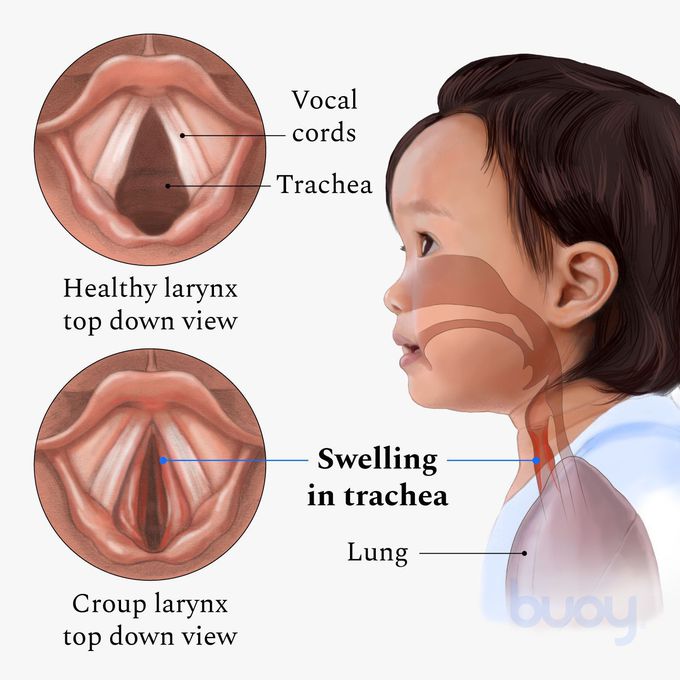 Cause of Croup