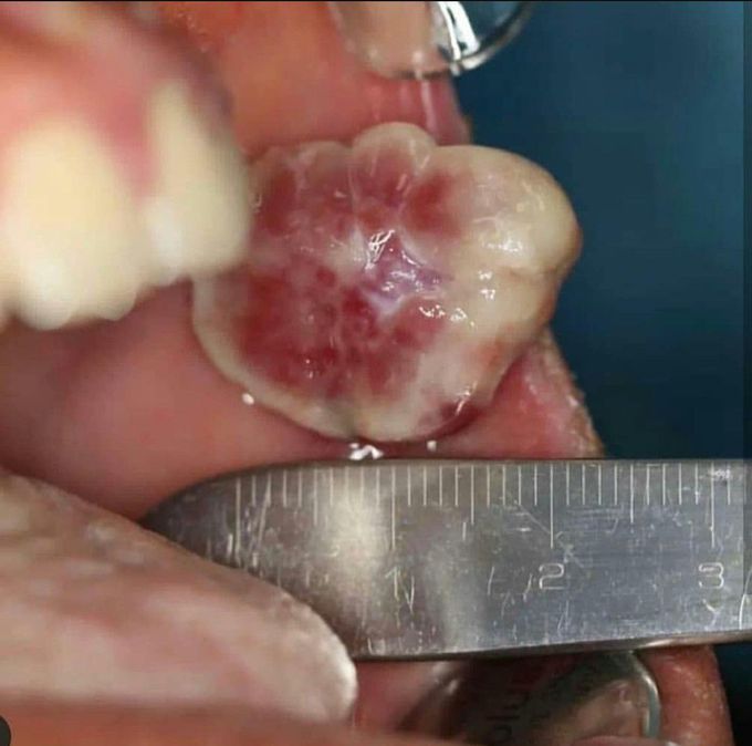 Granuloma