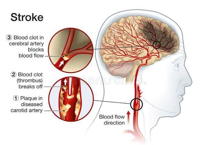 Causes of stroke