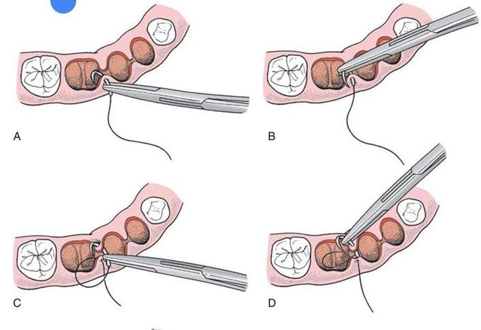 Suturing of flap