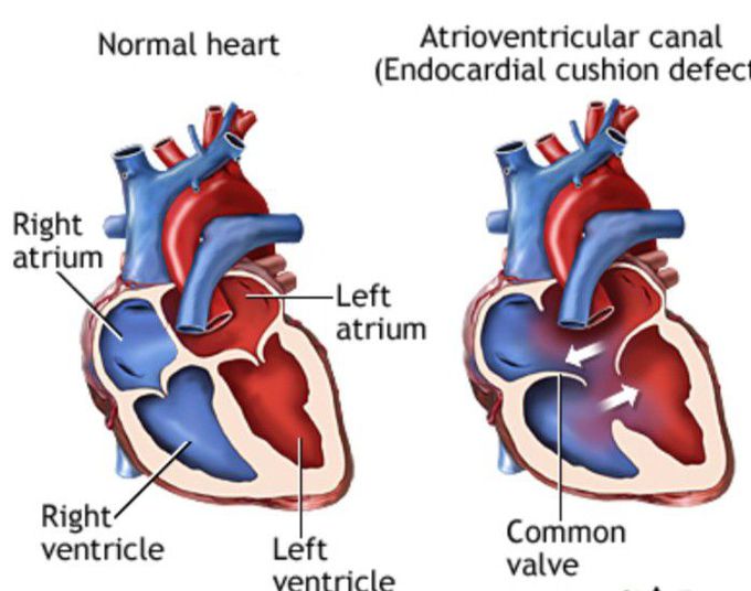 Symptoms of Endocardial cushion