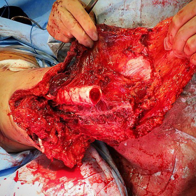 Above-Knee Amputation