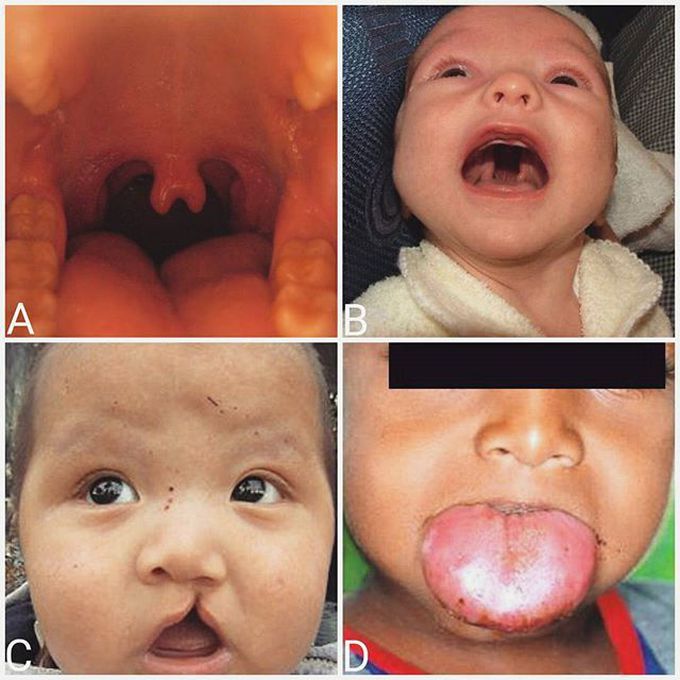 Cranial Facial Abnormalities