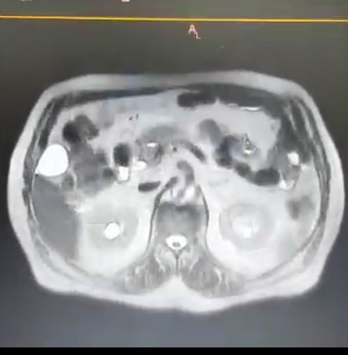 pancreas
