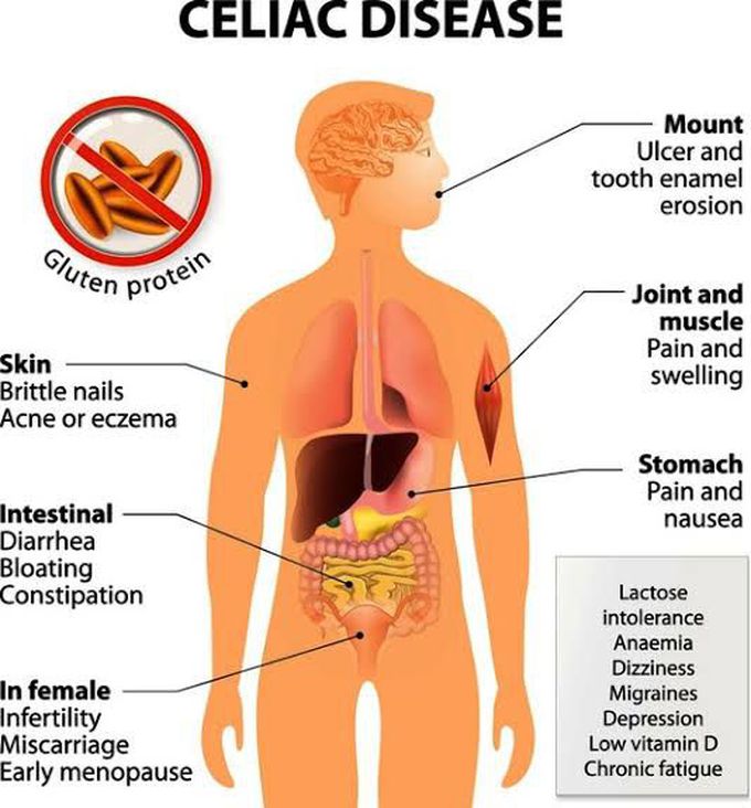 Celiac disease