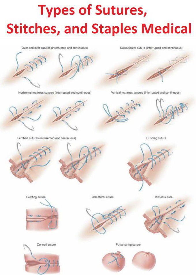 Suture