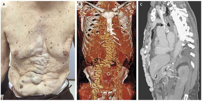 Chronic Occlusion of the Superior Vena Cava