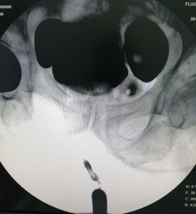 Retrograde urethrocystography