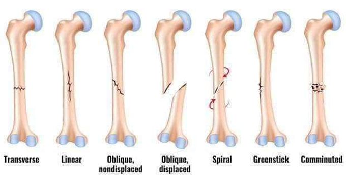 #Fractures