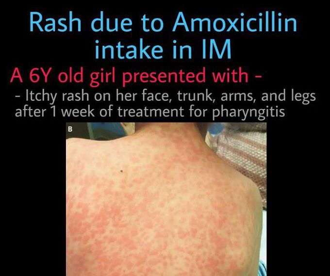 Rash due to Amoxicillin Intake