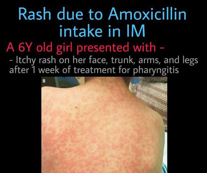 Rash Due To Amoxicillin Intake MEDizzy