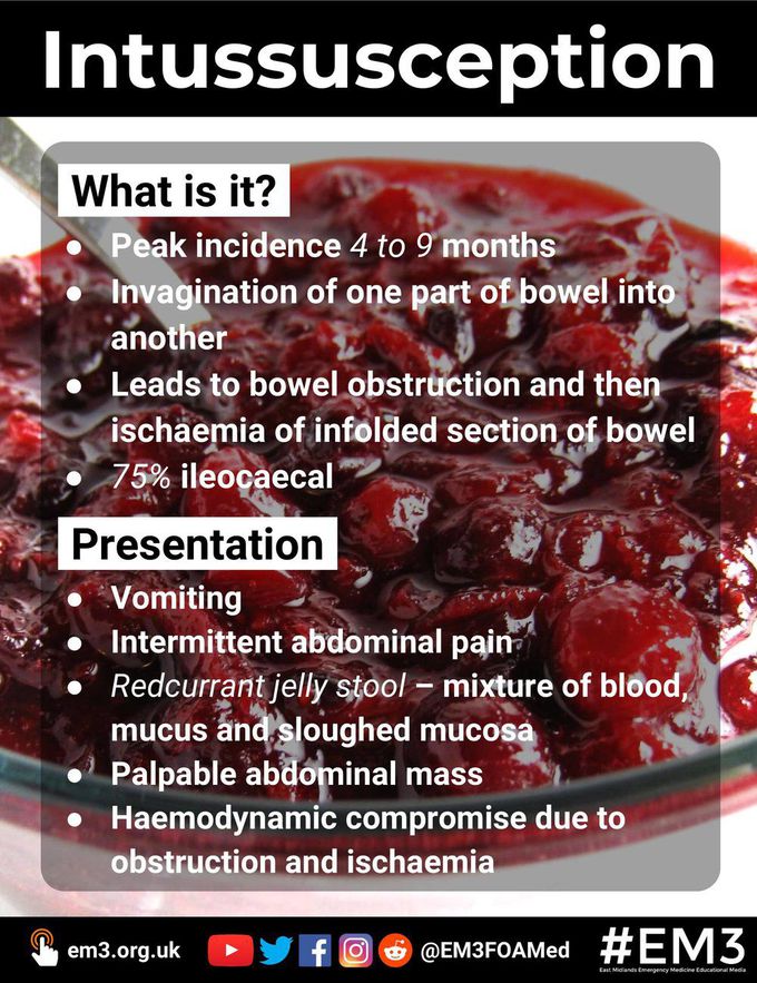 Intussusception