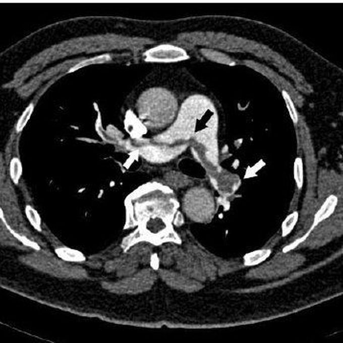 Pulmonary Embolism: Causes, Risk Factors, Signs and Symptoms, and Management